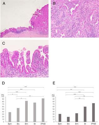 Novel insights into the intraepithelial spread of extrahepatic cholangiocarcinoma: clinicopathological study of 382 cases on extrahepatic cholangiocarcinoma